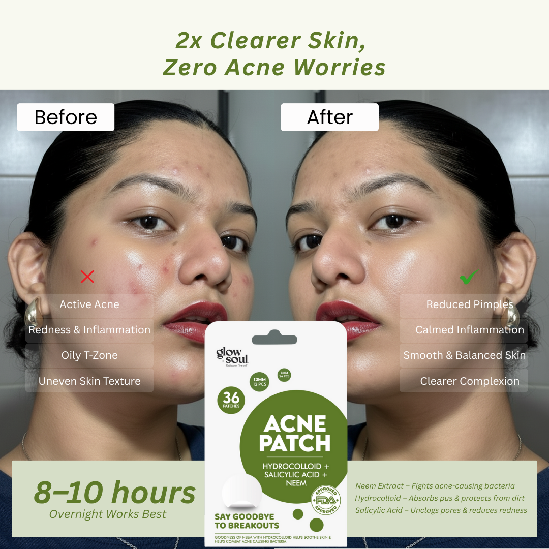 Neem infused Acne Patches With Hydrocolloid + Salicylic Acid (36 Patches)