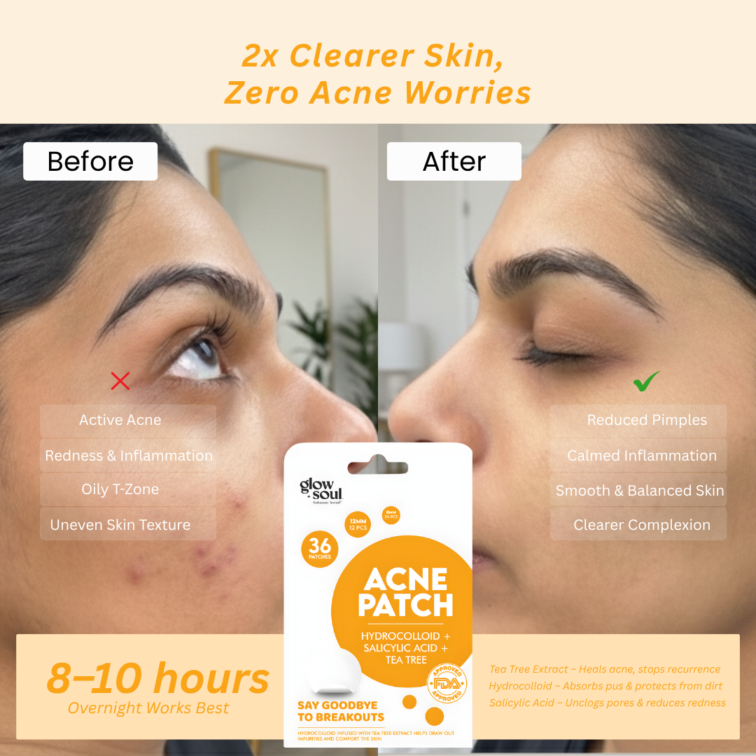 Tea Tree infused Acne Patches With Hydrocolloid + Salicylic Acid (36 Patches)