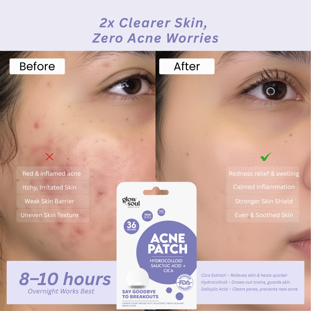 Cica infused Acne Patches With Hydrocolloid + Salicylic Acid (36 Patches)